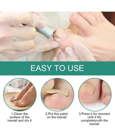 60 Pcs Toenail Correction Patch - Ingrown Toenail Corrector Tools for Perfect Pedicure - Buy Online on GoSupps.com