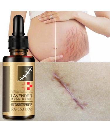 Allbesta Scar Repair Serum - Lavender Essence Essential Oil for Acne Burn & Stretch Marks Removal | Natural Skin Care 10ML - Buy Online on GoSupps.com