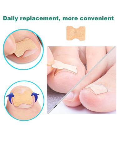 Ingrown Toenail Corrector Patch - 50PCS Natural Strips for Painless Treatment and Relief from Nail Groove - Glue-free Solution - Buy Online on GoSupps.com