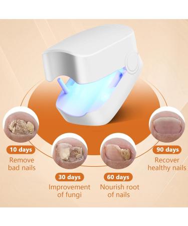 Nail Fungus Cleaning Device | Effective Light Treatment for Fingernails & Toenails | Improve Damaged & Discolored Nails - Buy Online on GoSupps.com