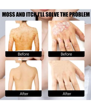 Xunnisa Meellop Herbal Psoriasis Relief Spray - Natural 30ml Soothing Treatment for All Skin - Buy Online on GoSupps.com