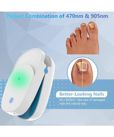 Nail Fungus Laser Treatment Device - Effective Onychomycosis Remover for Home Use | 470nm Blue Light 660nm Red Light 905nm Infrared Light - Buy Online on GoSupps.com