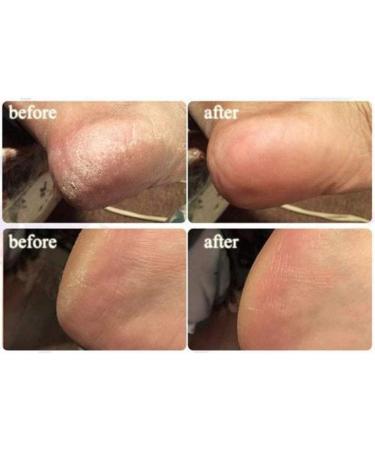 10pcs Ginger Foot Soak Effervescent Tablets for Anti-Swelling Foot SPA - Promotes Metabolism & Foot Care - Buy Online on GoSupps.com