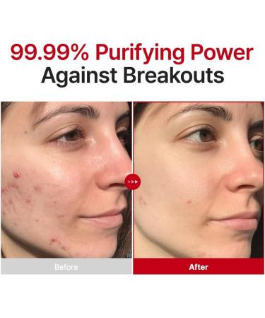 PURITO Hypochlorous Acid Facial Spray | Witch Hazel 5% + Forest Breeze | HOCl Facial Mist for Sensitive Redness-Prone Skin | Refreshing Toner Mist | Korean Skincare 100mL / 3.38 fl.oz - Buy Online on GoSupps.com