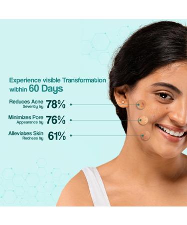 Anti-Acne Moisturizer - Venusia Lotion 2.6oz | Controls Oil Production & Hydrates Skin - Buy Online on GoSupps.com