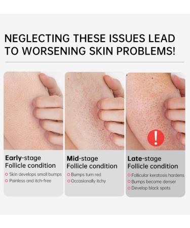 Skin Exfoliating Repair Cream Chicken Skin Care Cream Strawberry Legs Treatment Body Cream - Buy Online on GoSupps.com