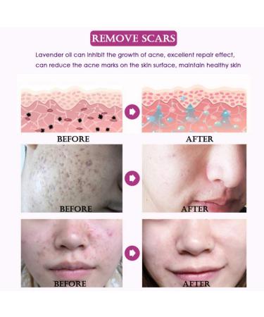 Allbesta Scar Repair Serum - Lavender Essence Essential Oil for Acne Burn & Stretch Marks Removal | Natural Skin Care 10ML - Buy Online on GoSupps.com
