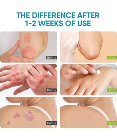 YURHERSU Psoriasis Cream Anti-Itch Helps Relieveitching Redness Flaking Irritation Dandruff Scalling of Scalp Psoriasis Seborrheic Dermatitis Not Sticky Moisturizing Easy Absorb for Daily Skin Care - Buy Online on GoSupps.com