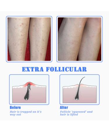 TailaiMei Exfoliating Brush - Ingrown Hair & Bikini Bump Treatment - Smooth Skin Solution for Men & Women - Buy Online on GoSupps.com