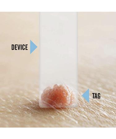 Tagcure Skin Tags Remover Kit - Easy Wart Mole & Skin Tag Removal at Home - 'Plus' Device for 0.5cm+ Skin Tags - Buy Online on GoSupps.com