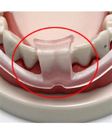 Tooth Brace Anti Teeth-Grinding Dental Guard | Molar Braces Sleep Protector | International Shipping Available - Buy Online on GoSupps.com