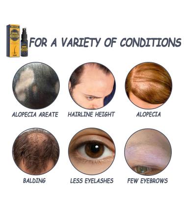 Best Hair Growth Spray & Serum | Anti-Hair Loss Treatment for Thicker Faster Hair Growth - Shop Now! - Buy Online on GoSupps.com