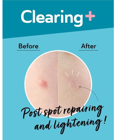 DERMA ANGEL Ultra Invisible Dark Spot Patches â€“ Acne & Pimple Treatment for Face - 96 Count - Buy Online on GoSupps.com