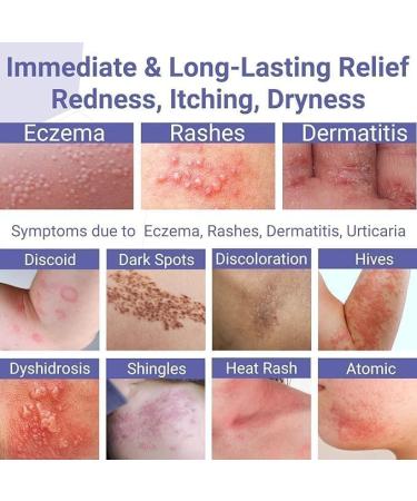 ishancare Eczema Cream Eczema-Prone Skin Treatment Ointment Relief Redness Itching Dryness Rash Dermatitis Natural Soothing & Moisturizing for Full Body 1.7 Ounce - Buy Online on GoSupps.com