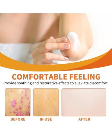 Todahof Bee Venom Psoriasis Treatment Cream Bee Venom Psoriasis Treatment Cream Todahof Bee Venom Relief Cream Todahof Bee Venom Ointment Psoriasis Cream 30 g (1 Piece) 1 Piece. - Buy Online on GoSupps.com