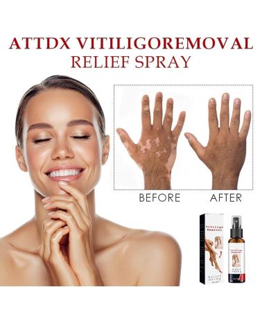 Kolmax Vitiligo Relief Spray - 2 PCS Set for Skin Care | Vitiligo Removal and White Spot Treatment - Buy Online on GoSupps.com