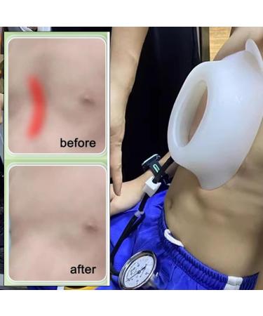 Vacuum Bell Pectus Excavatum - Physical Correction Pectus Excavatum Orthosis Brace Real-Time Pressure Gauge Monitoring(Small) - Buy Online on GoSupps.com