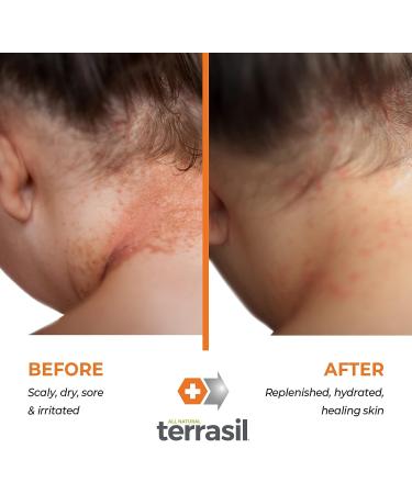 Terrasil Eczema and Psoriasis Cream | Calendula & Natural Ingredients | Eczema Relief for Severe Outbreaks | Soothes Rashes & Rosacea | Repairs Dry, Itchy Skin | 28g - Buy Online on GoSupps.com