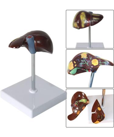 Liver Pathology Model Fatty Cirrhosis Carcinoma Demonstration Model Shows 7 Liver Diseases Detachable 2 Parts for Doctors Office Educational Tool - Buy Online on GoSupps.com