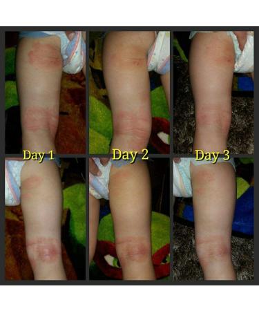 Soothe My Skin Cream - Natural Eczema, Psoriasis & Dermatitis Relief with Emu Oil - Buy Online on GoSupps.com