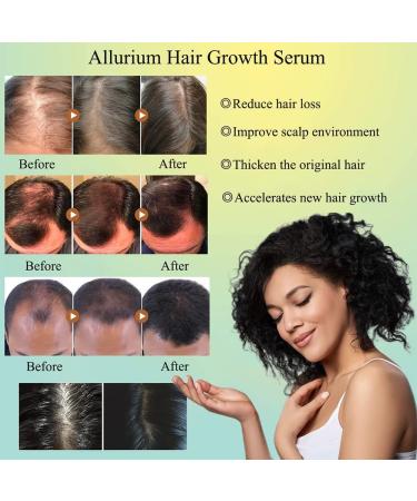 2023 Allurium Hair Growth Serum for Black Women - Nourish Dry, Damaged Hair Fast - Natural Hair Growth - 4PCS - Buy Online on GoSupps.com