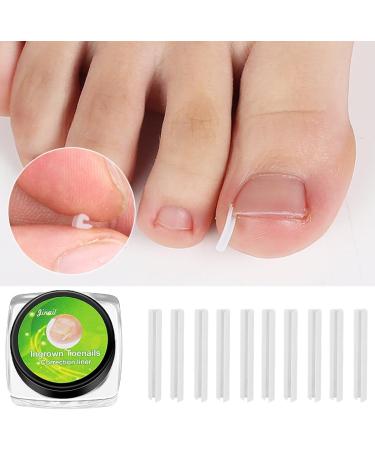 (12 +3) Ingrown Toenail Correction Treatment Kit Ingrown Toenail Correction Strips Brace Kit Ingrown Toenail File and Lifter Ingrown Toenail Corrector Straightener Strips for Nail Foot Care - Buy Online on GoSupps.com