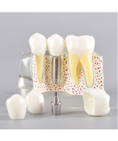Dental Model Dentist Dental implant Model Resin Material Removable Used for Dental Clinic Research and Doctor-Patient Communication - Buy Online on GoSupps.com