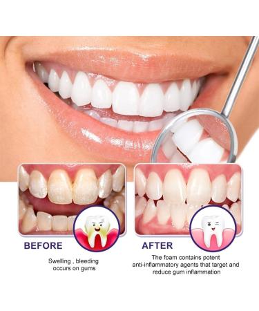 EXQST Gum Treatment Foam Gum Tissue Regeneration and Repair Deep Stain Cleaning Gum Treatment Foam Deeply Cleaning Gums Stain Removal Deep Stain Cleaning Gum Treatment Foam 1pcs - Buy Online on GoSupps.com