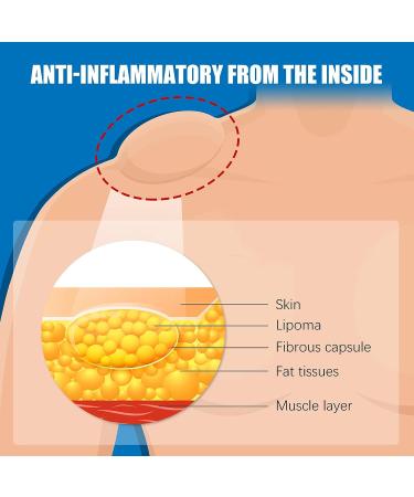 Lipoma Removal Cream 20g - Natural Treatment for Lipoma Care & Discomfort - Buy Online on GoSupps.com