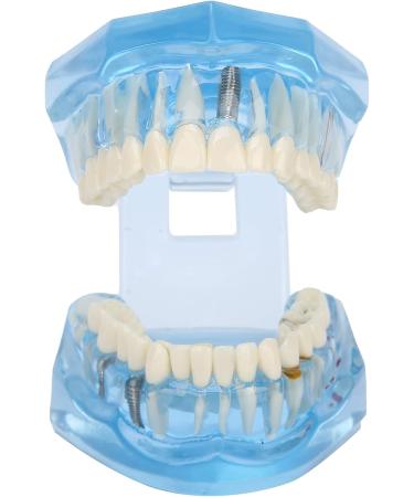 Adult Dental Implant Tooth Model - Blue-Transparent Acrylic for Pedagogical Demonstration | Removable Simulation for Dentists - Buy Online on GoSupps.com