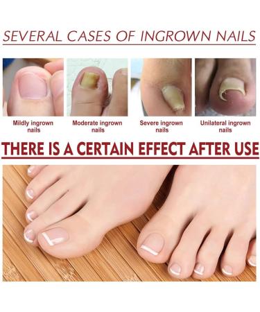 German Toenailcare Paronychia & Bunion Relief Oil for Thick, Discolored Nails - 1Pcs - Buy Online on GoSupps.com
