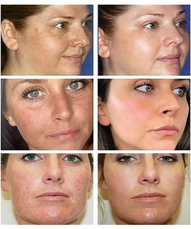 SGHOPLG 3Pcs Effective Whitening Freckle CreamRemove Melasma Acne Cream Fading Spot CreamAcne Scar Removal TreatmentFade Pigmentation Anti Melasma Brighten Skin Care Creams - Buy Online on GoSupps.com