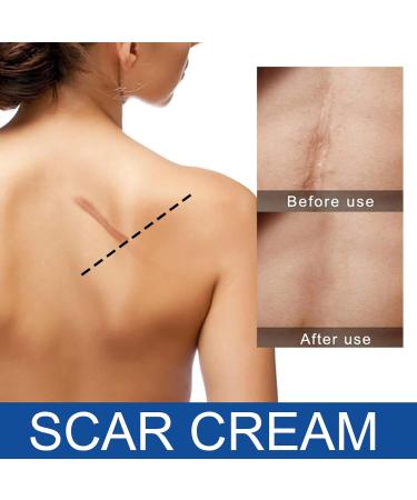 Best Scar Cream for All Types | Scar Angel - Effective Silicone Ointment for Stretch Marks & Post-Op Care - Buy Online on GoSupps.com
