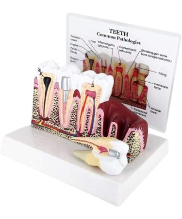 PSVOD 4x4 Anatomy Models for Dental Diseases | Educational Tools for Oral Care & Teaching - Buy Online on GoSupps.com