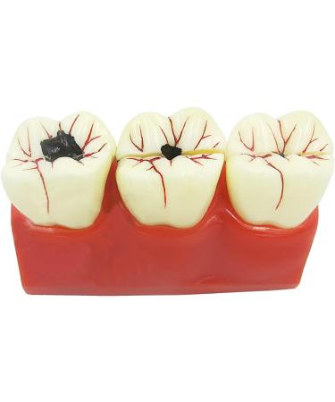 Buy Samnuerly 4-Fold Dental Teeth Caries Model - Removable Tooth Pathology & Evolutionary Display for Dental Training | International Shipping Available - Buy Online on GoSupps.com