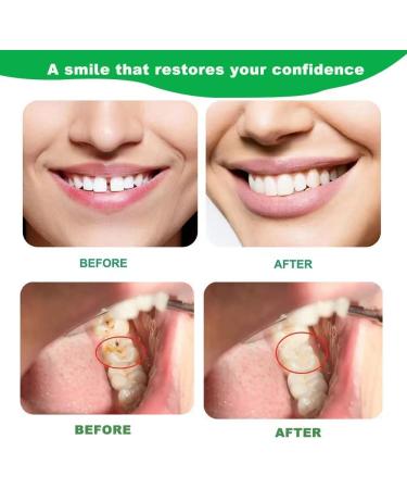 Buy Dental Repair Kit for Missing or Broken Teeth Quick & Safe Solution to Regain Your Smile at Home - Buy Online on GoSupps.com