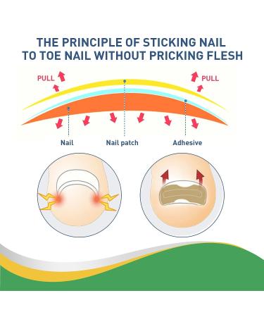 Fitmedify Nail Patches - 150 Pcs Ingrown Toenail Correction Stickers for Professional Foot Care - Buy Online on GoSupps.com