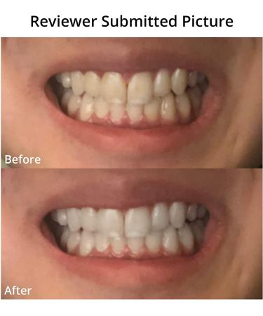 Taeity Teeth Whitening Strips - Non-Sensitive Strong Formula (28 Strips) - Buy Online on GoSupps.com