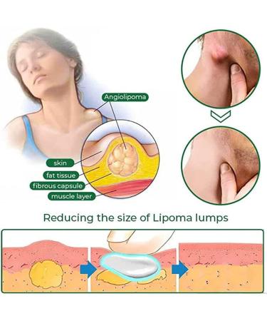 YSGBYSG LipomaCure Ointment 20g - 5PCS | Lump-Free Lipoma Removal Cream for Skin Anti-Swelling - Buy Online on GoSupps.com