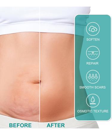 IBUGER Scarremove Advanced Scar Spray - Medical Grade Scar Remover for All Types of Scars | 1pcs - Buy Online on GoSupps.com