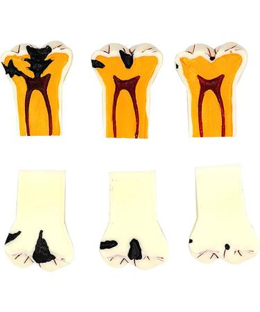 Buy Samnuerly 4-Fold Dental Teeth Caries Model - Removable Tooth Pathology & Evolutionary Display for Dental Training | International Shipping Available - Buy Online on GoSupps.com