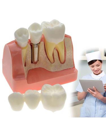 Samnuerly 4-fold dental implant crown bridge demonstration model comparison of the results between implant and porcelain bridge for patient communication