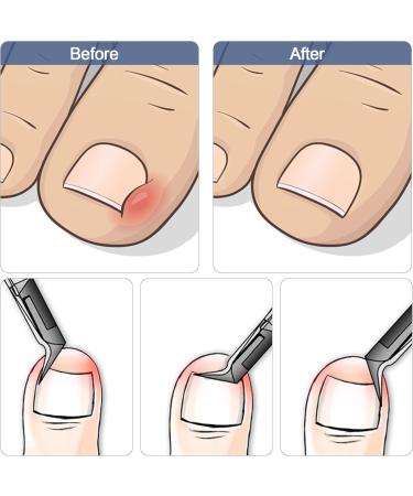 EEEKit Ingrown Toenail Clippers Professional Pedicure Thick Toenail Straight Blade Cutter Tool for Seniors - Buy Online on GoSupps.com