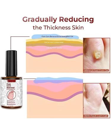 Gfouk Foot Corn Removal Gel 10ml - Extra Strength Liquid Treatment (3Pcs) - Buy Online on GoSupps.com
