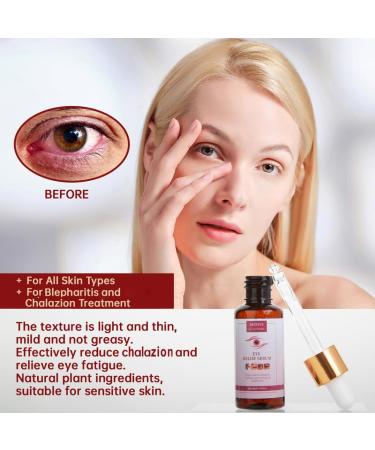 Chalazion Eye Treatment & Blepharitis Relief - 30ml Under Eye Serum for Dark Circles Puffiness & Moisturizing Eyelids - Buy Online on GoSupps.com