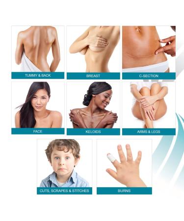 NewGel+ Advanced Silicone Scar Treatment Tape for Abdomen & Extremity - REUSABLE - Clear - Buy Online on GoSupps.com