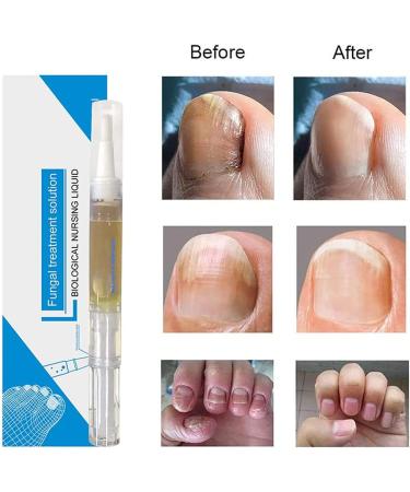 Okita Toenail Fungus Treatment Pen - Effective Nail Repair for Healthy and Strong Nails (5Pcs) - Buy Online on GoSupps.com