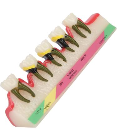 Shop Verdant Touch Tooth Model - Dental Periodontal Disease Study Tool for Schools | International Shipping Available - Buy Online on GoSupps.com