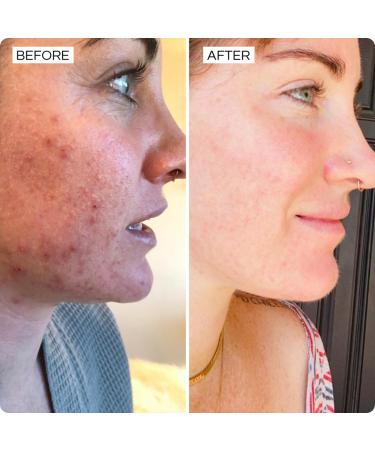 SONYA DAKAR Super Clear Serum - Acne Fighting with Salicylic Acid & Niacinamide | Minimize Pores Reduce Inflammation & Blemishes | International Shipping Available - Buy Online on GoSupps.com