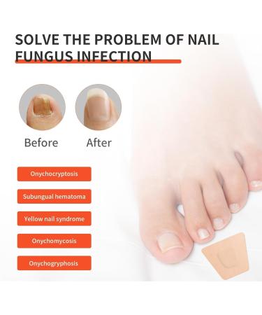 Extra Strength Toenail Fungus Treatment - 32 Pcs Nighttime Renewal Patch for Fast Relief & Visible Results - Buy Online on GoSupps.com